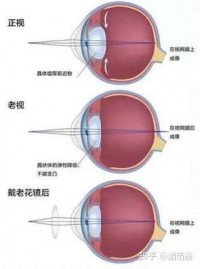 老年人视力保护：老花眼怎么选眼镜，日常用眼注意啥？​